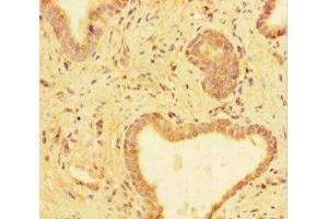 Immunohistochemistry of paraffin-embedded human prostate cancer using ABIN7173659 at dilution of 1:100 (TUBA1C antibody  (AA 29-184))