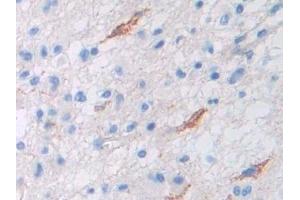 Detection of Pgp in Human Glioma Tissue using Polyclonal Antibody to Permeability Glycoprotein (Pgp) (Permeability Glycoprotein antibody  (AA 394-672))