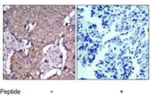 Immunohistochemical analysis of paraffin-embedded human breast carcinoma tissue using ERBB2 polyclonal antibody  .