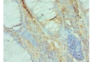 Immunohistochemistry of paraffin-embedded human colon cancer using ABIN7152531 at dilution of 1:100 (GFER antibody  (AA 81-205))