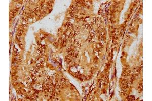 IHC image of ABIN7127500 diluted at 1:180 and staining in paraffin-embedded human endometrial cancer performed on a Leica BondTM system. (Recombinant FOXO3 antibody)