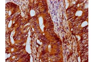 IHC image of ABIN7156973 diluted at 1:400 and staining in paraffin-embedded human colon cancer performed on a Leica BondTM system. (IFT172 antibody  (AA 1368-1502))