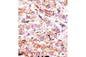 Formalin-fixed and paraffin-embedded human cancer tissue reacted with the primary antibody, which was peroxidase-conjugated to the secondary antibody, followed by AEC staining. (GUCY1A2 antibody  (N-Term))
