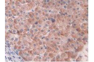 IHC-P analysis of Human Liver Cancer Tissue, with DAB staining. (HIF1A antibody  (AA 218-506))