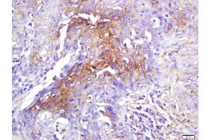 Formalin-fixed and paraffin embedded human laryngeal tissue labeled with Rabbit Anti-eIF4H Polyclonal Antibody, Unconjugated (ABIN2559623) at 1:200 followed by conjugation to the secondary antibody and DAB staining