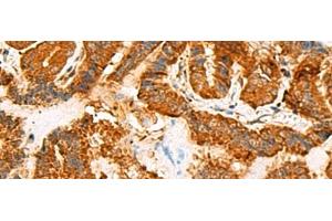 Immunohistochemistry of paraffin-embedded Human thyroid cancer tissue using ASMTL Polyclonal Antibody at dilution of 1:100(x200)