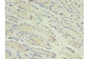 Immunohistochemistry of paraffin-embedded human gastric cancer using ABIN7150974 at dilution of 1:100 (RANBP2 antibody  (AA 2601-2802))