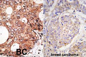 Formalin-fixed and paraffin-embedded human breast carcinoma tissue reacted with MAGEA10 polyclonal antibody  , which was peroxidase-conjugated to the secondary antibody, followed by DAB staining. (MAGEA10 antibody  (C-Term))