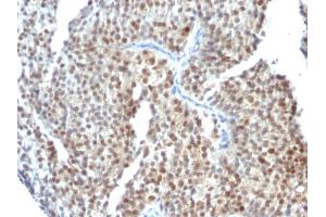 Formalin-fixed, paraffin-embedded human Bladder Carcinoma stained with ER-beta Mouse Monoclonal Antibody (ESR2/686). (ESR2 antibody  (C-Term))