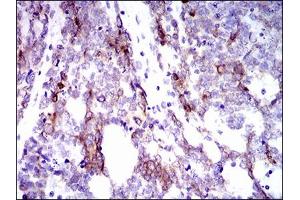 Immunohistochemical analysis of paraffin-embedded esophageal cancer tissues using CK5 mouse mAb with DAB staining. (Cytokeratin 5 antibody  (AA 316-590))