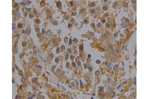 Immunohistochemical staining of human liver cancer tissue section with PRDX6 monoclonal antibody, clone 36  at 1:100 dilution. (Peroxiredoxin 6 antibody)