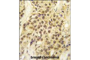Formalin-fixed and paraffin-embedded human breast carcinoma tissue reacted with HMOF/MYST1 antibody , which was peroxidase-conjugated to the secondary antibody, followed by DAB staining.