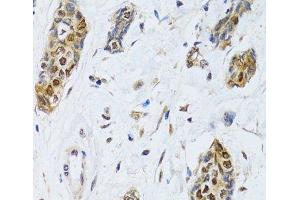 Immunohistochemistry of paraffin-embedded Human breast cancer using CIRBP Polyclonal Antibody at dilution of 1:100 (40x lens).