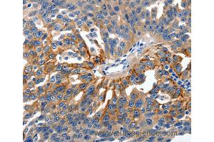 Immunohistochemistry of Human ovarian cancer using CLDN1 Polyclonal Antibody at dilution of 1:150 (Claudin 1 antibody)