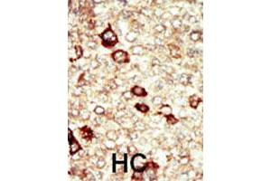 Formalin-fixed and paraffin-embedded human hepatocellular carcinoma tissue reacted with FGFR4 polyclonal antibody  , which was peroxidase-conjugated to the secondary antibody, followed by AEC staining. (FGFR4 antibody  (N-Term))