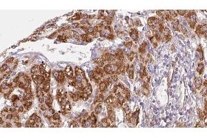 ABIN6279060 at 1/100 staining Human liver cancer tissue by IHC-P. (ACVR2B antibody  (Internal Region))