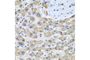 Immunohistochemistry of paraffin-embedded human liver cancer using GFM1 antibody.
