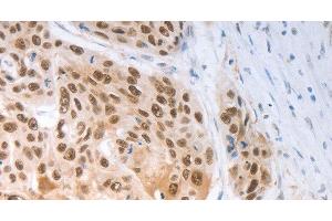 Immunohistochemistry of paraffin-embedded Human ovarian cancer tissue using SLC22A8 Polyclonal Antibody at dilution 1:70 (SLC22A8 antibody)