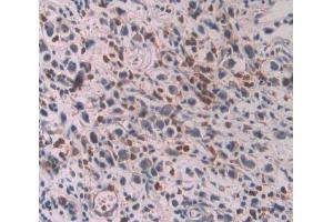 IHC-P analysis of stomach cancer tissue, with DAB staining. (OAS1 antibody  (AA 74-165))