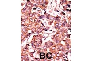Formalin-fixed and paraffin-embedded human cancer tissue reacted with CDC25A (phospho S278) polyclonal antibody  which was peroxidase-conjugated to the secondary antibody followed by AEC staining. (CDC25A antibody  (pSer279))