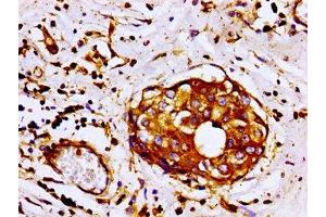 Immunohistochemistry of paraffin-embedded human breast cancer using ABIN7152944 at dilution of 1:100 (Filamin A antibody  (AA 1234-1462))