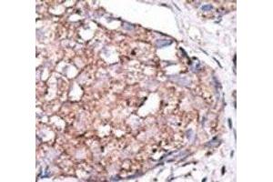 IHC analysis of FFPE human hepatocarcinoma stained with the SIGLEC7 antibody (SIGLEC7 antibody  (AA 407-438))