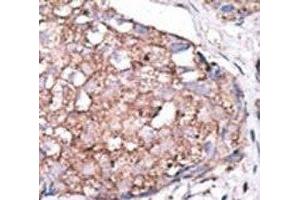 IHC analysis of FFPE human hepatocarcinoma stained with the SIGLEC7 antibody