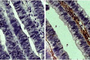 Paraffin embedded human gastric cancer tissue was stained with Goat IgG-UNLB isotype control, DAB, and hematoxylin. (COL3 antibody  (Biotin))