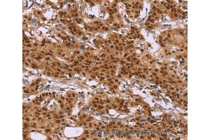 Immunohistochemistry of Human liver cancer using CTNNBL1 Polyclonal Antibody at dilution of 1:50 (CTNNBL1 antibody)