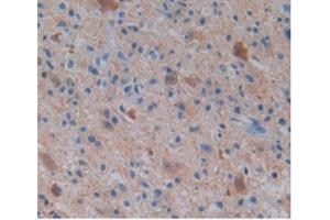 IHC-P analysis of Human Glioma Tissue, with DAB staining. (ENO2/NSE antibody  (AA 1-434))