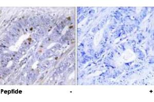 Immunohistochemical analysis of paraffin-embedded human colon carcinoma tissue using NR4A1 polyclonal antibody .