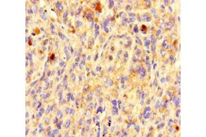 Immunohistochemistry of paraffin-embedded human melanoma using ABIN7162191 at dilution of 1:100