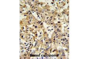 CA6 Antibody (C-term) IHC analysis in formalin fixed and paraffin embedded breast carcinoma followed by peroxidase conjugation of the secondary antibody and DAB staining. (CA6 antibody  (C-Term))