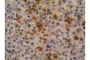 Immunohistochemistry of paraffin-embedded sections (hepatocellular carcinoma) Immunohistochemistry staining of hepatocellular carcinoma (fetal liver; paraffin-embedded sections) with anti-human alpha-Fetoprotein (AFP-11). (alpha Fetoprotein antibody)