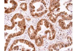 IHC-P Image Immunohistochemical analysis of paraffin-embedded human lung cancer, using CIS, antibody at 1:100 dilution. (CISH antibody  (C-Term))