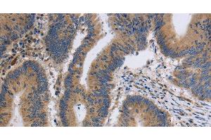 Immunohistochemistry of paraffin-embedded Human colon cancer tissue using ITPR1 Polyclonal Antibody at dilution 1:40 (ITPR1 antibody)