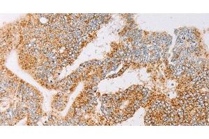 Immunohistochemistry of paraffin-embedded Human colon cancer tissue using YARS2 Polyclonal Antibody at dilution 1:30 (YARS2 antibody)