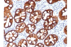 Formalin-fixed, paraffin-embedded human Colon Carcinoma stained with EpCAM Mouse Recombinant Monoclonal Antibody (rMOC-31). (Recombinant EpCAM antibody)