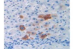 IHC-P analysis of Human Liver Cancer Tissue, with DAB staining. (Relaxin 2 antibody  (AA 1-186))