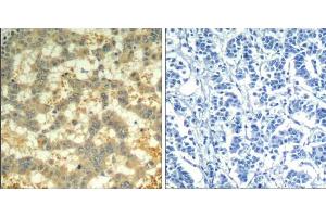 Immunohistochemical analysis of paraffin-embedded human breast carcinoma tissue using syk (phospho-Tyr323) Antibody (E011546). (SYK antibody  (pTyr323))