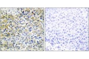 Immunohistochemistry analysis of paraffin-embedded human liver carcinoma tissue, using CARKL Antibody. (SHPK antibody  (AA 31-80))