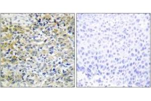 Immunohistochemistry analysis of paraffin-embedded human liver carcinoma tissue, using CARKL Antibody.