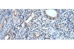 Immunohistochemistry of paraffin-embedded Human cervical cancer tissue using USP32 Polyclonal Antibody at dilution of 1:75(x200) (USP32 antibody)
