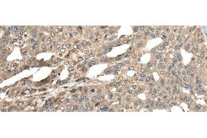 Immunohistochemistry of paraffin-embedded Human liver cancer tissue using MCPH1 Polyclonal Antibody at dilution of 1:110(x200) (MCPH1 antibody)