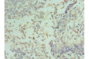 Immunohistochemistry of paraffin-embedded human cervical cancer using ABIN7153389 at dilution of 1:100 (Cyclin D2 antibody  (AA 1-289))