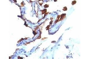 Formalin-fixed, paraffin-embedded human lung carcinoma stained with Cytokeratin 8 + 18 antibody (C-51). (Cytokeratin 8/18 antibody)
