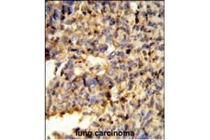 Formalin-fixed and paraffin-embedded human lung carcinoma reacted with FCGR2C Antibody (C-term), which was peroxidase-conjugated to the secondary antibody, followed by DAB staining. (FCGR2C antibody  (C-Term))