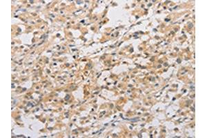 The image on the left is immunohistochemistry of paraffin-embedded Human thyroid cancer tissue using ABIN7128532(ARSF Antibody) at dilution 1/20, on the right is treated with fusion protein. (ARSF antibody)