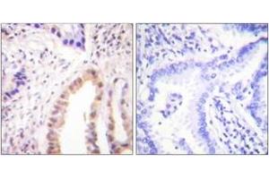 Immunohistochemistry analysis of paraffin-embedded human lung carcinoma, using MEF2D (Phospho-Ser444) Antibody. (MEF2D antibody  (pSer444))