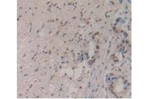 DAB staining on IHC-P; Samples: Human Pancreas Cancer Tissue. (MSTN antibody  (AA 267-375))